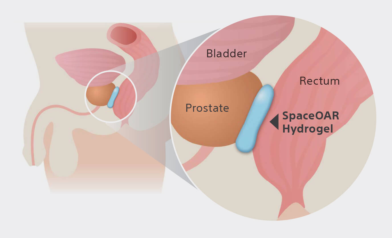 spaceoar-prostate.jpg