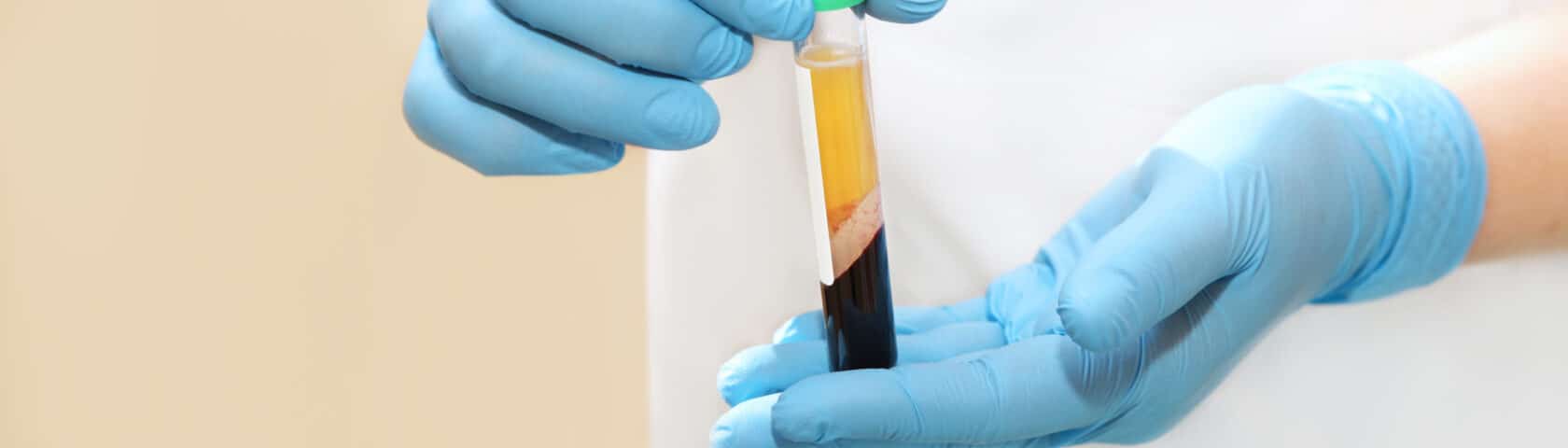 Platelet-Rich Plasma