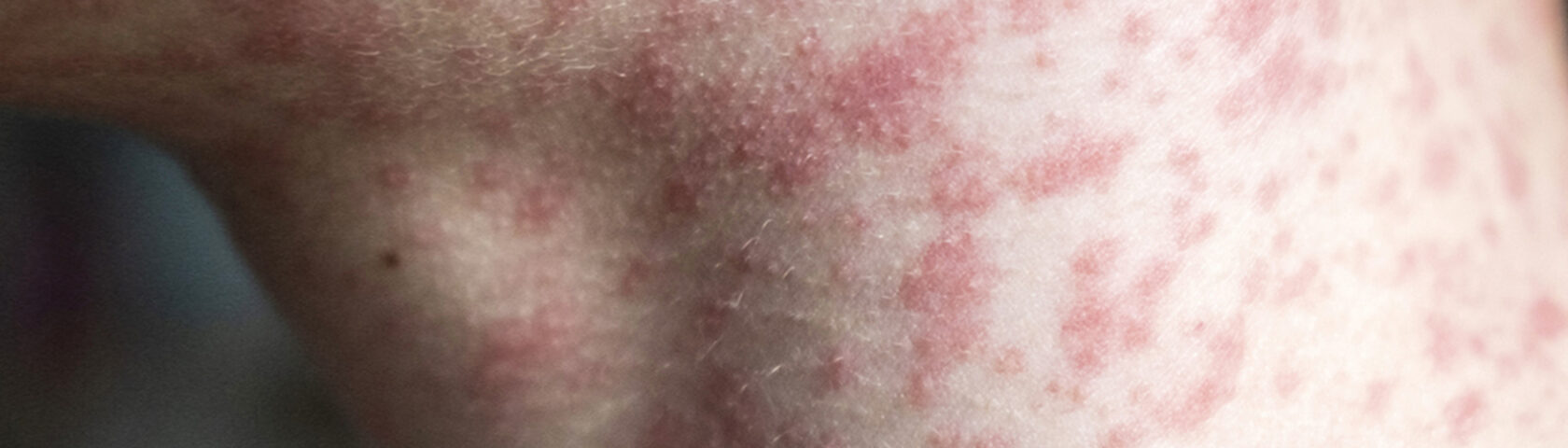 Stay Informed, Stay Protected: What You Need to Know About Measles