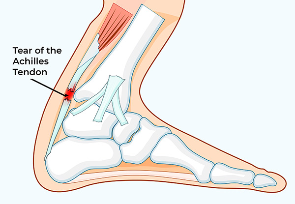 Medical illustration showing a tear of the Achilles tendon near the heel, highlighting the area commonly treated with Achilles tendon repair surgery.