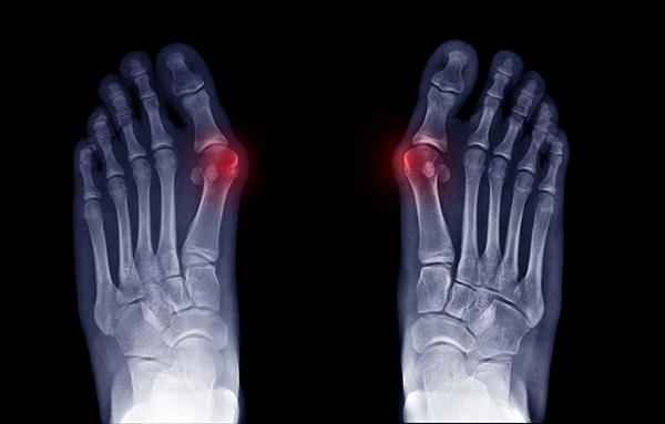 Illustration showing hallux valgus bunion and tailor’s bunion locations on the foot, highlighting painful joint areas commonly treated with bunion surgery.