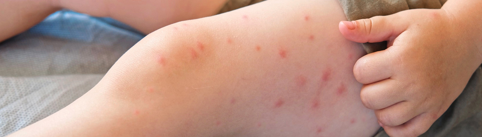 What You Need to Know About Measles