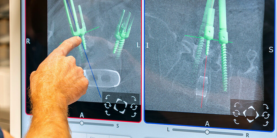 Surgeon at CRMC uses the VELYS™ Robotic Assistance system, reviewing real-time spinal imaging during robotic spine surgery on a digital screen.